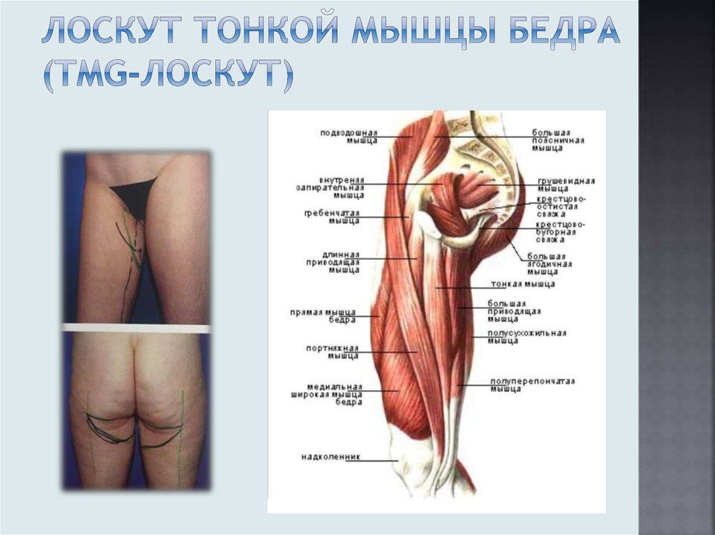 Лоскут тонкой мышцы бедра (TMG-лоскут)