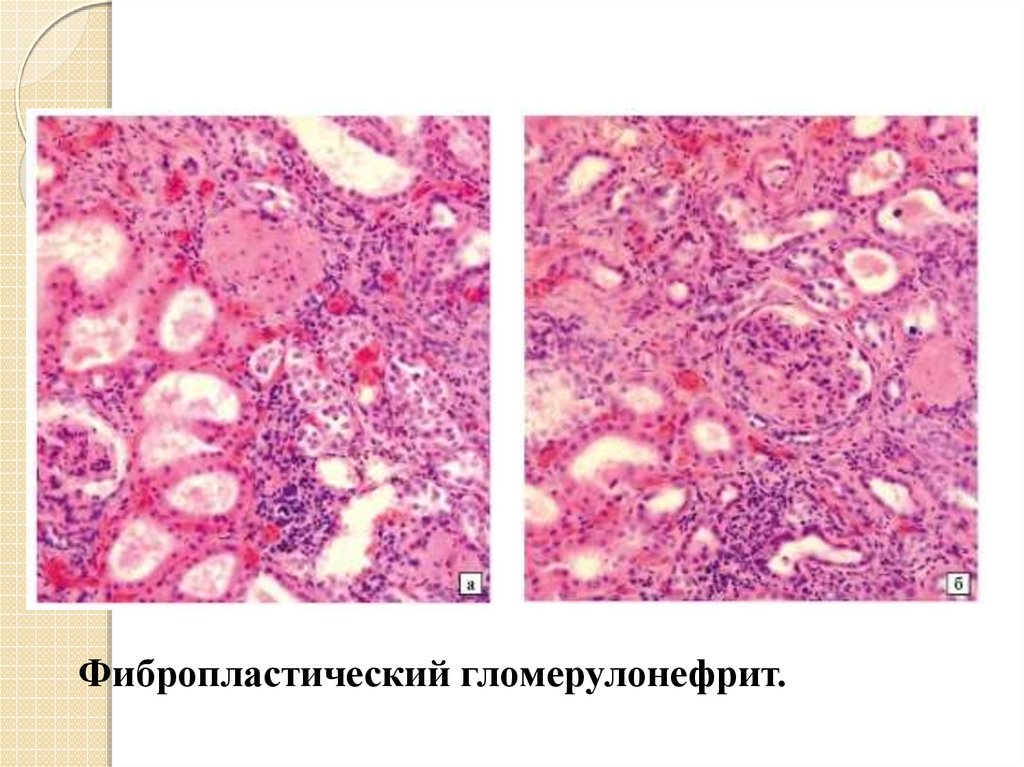 Морфологическая картина гломерулонефрита