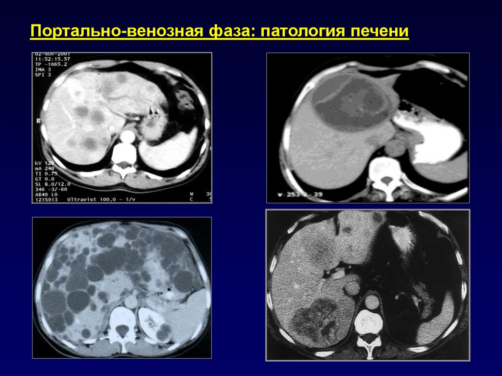 Как часто кт. Венозный инфаркт кт на кт. Портальная венозная фаза кт.