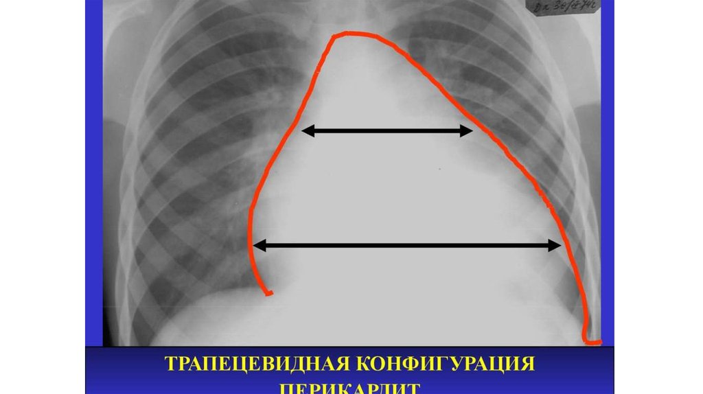 Границы расширены влево. Трапециевидная конфигурация сердца рентген. Трапециевидная конфигурация сердца на рентгенограмме. Митральная форма сердца рентген. Треугольная форма сердца на рентгенограмме.
