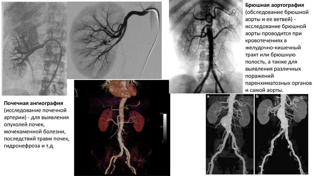 Почечная ангиография презентация
