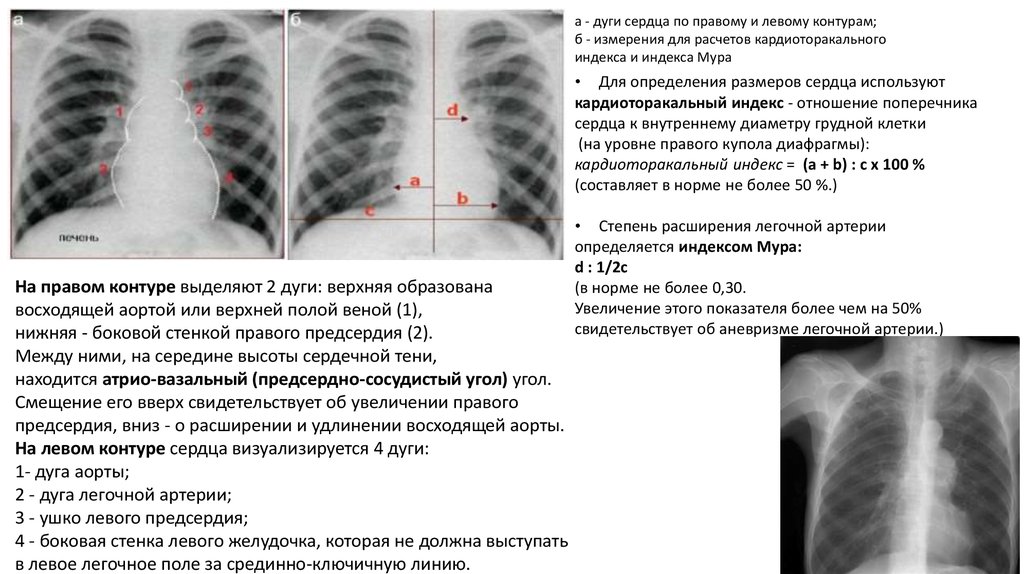 Увеличено правое. Выбухание дуги легочной артерии. Выбухание дуги легочной артерии на рентгене. Дуга легочной артерии на рентгене. Выбухает дуга легочной артерии.