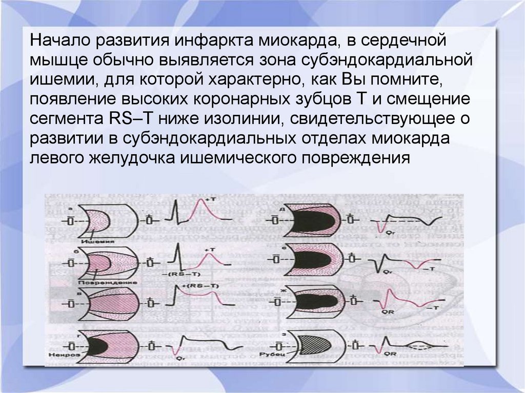 Дрейф изолинии на экг что это. Плавание изолинии на ЭКГ. М режим ЭКГ. Фонокардиограмма  сегменты.