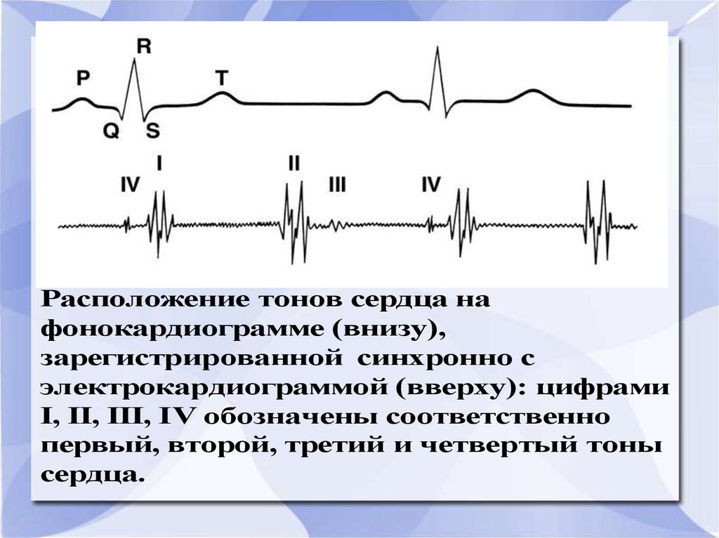 V2 на экг