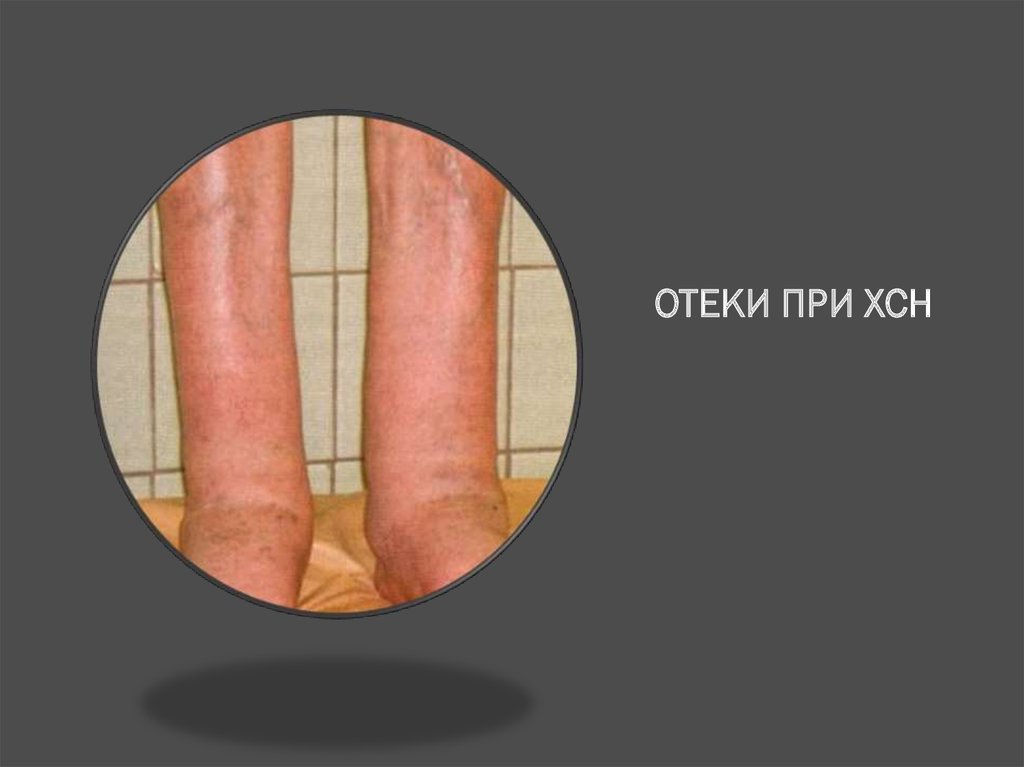 ОТЕКИ ПРИ ХСН