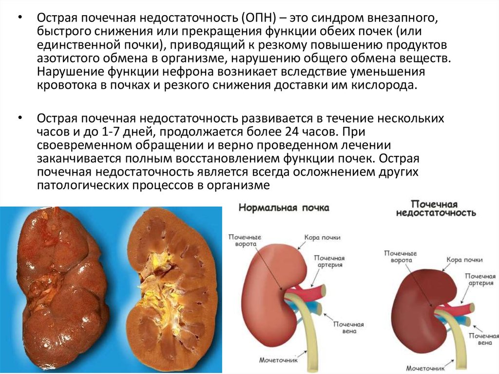 Острая почечная недостаточность картинки