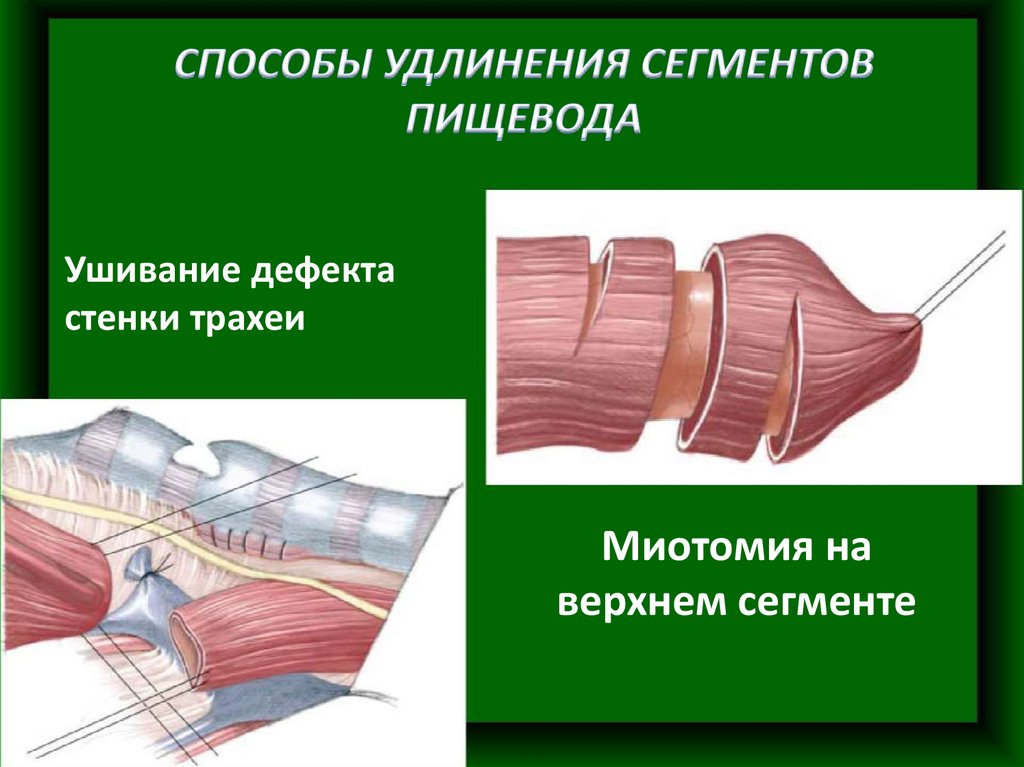 Трахеопищеводный свищ презентация