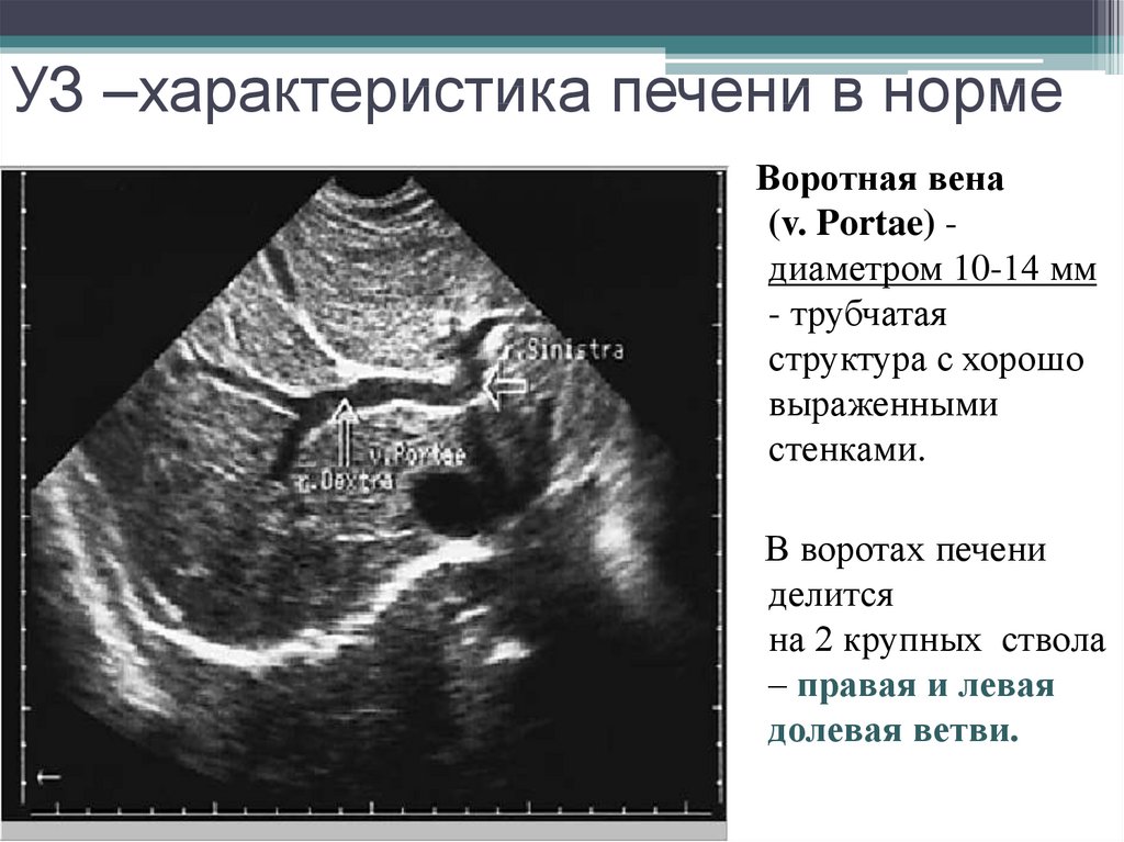 Диагностика портальной гипертензии при ультразвуковой ангиографии печени