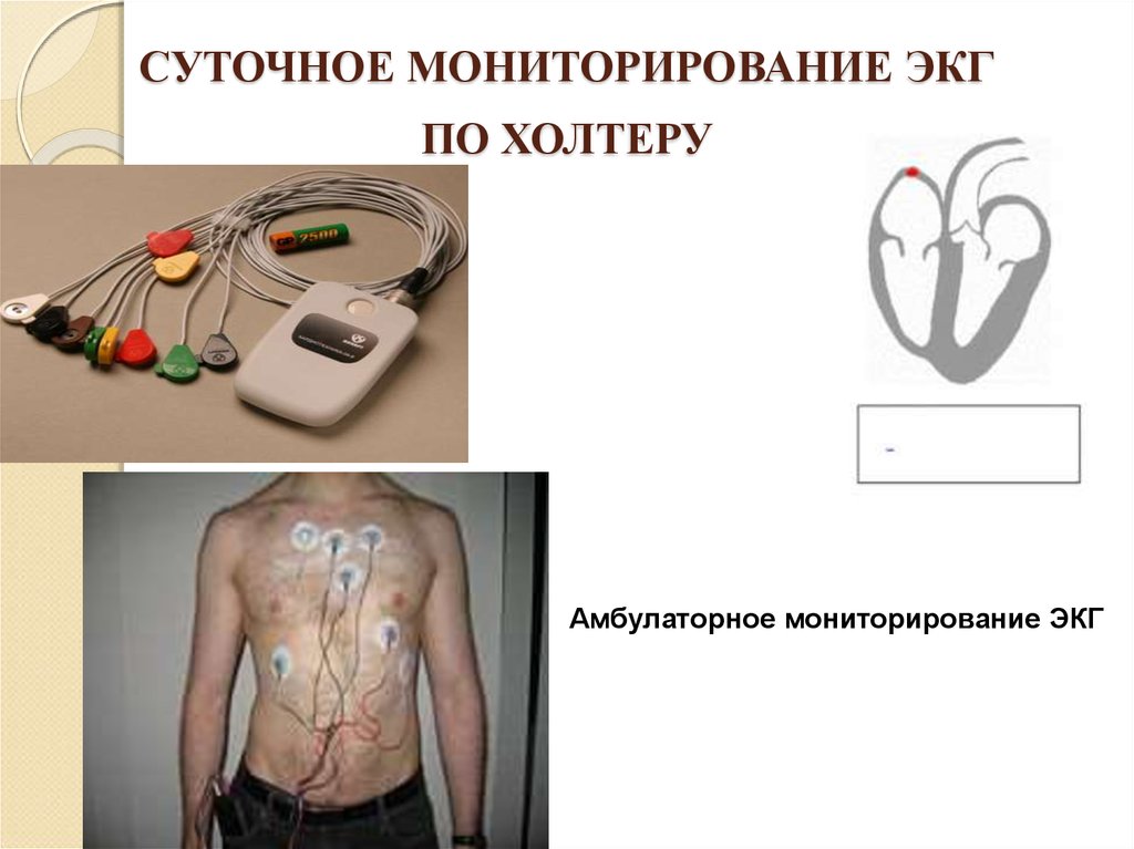 Установка холтера схема наложения 10 электродов