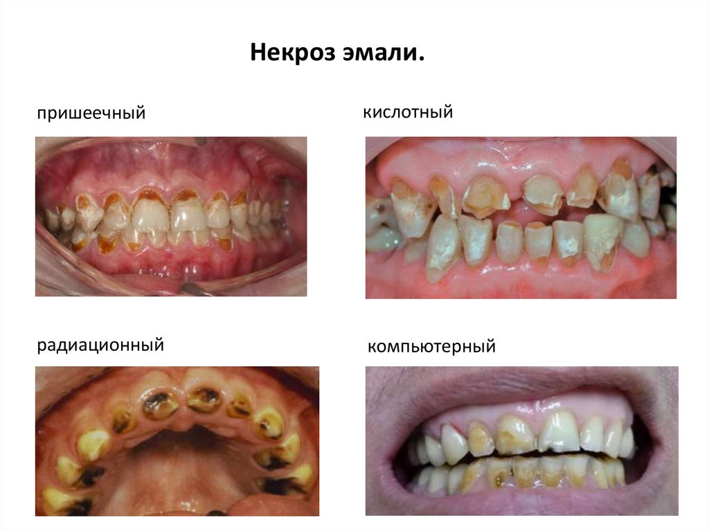 Некариозные поражения зубов после прорезывания зубов презентация