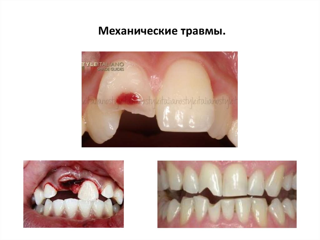 Некариозные поражения зубов после прорезывания зубов презентация