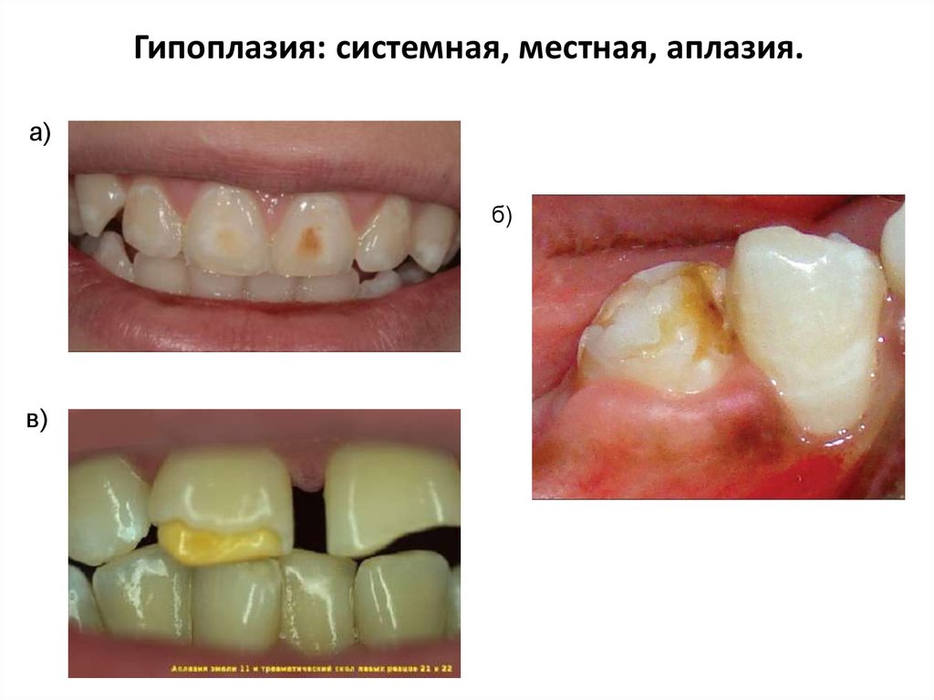 Некариозные поражения зубов после прорезывания зубов презентация