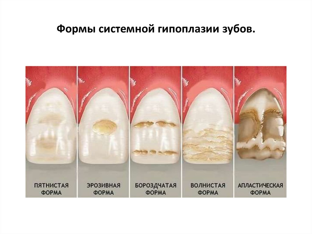 Презентация некариозные поражения твердых тканей зубов