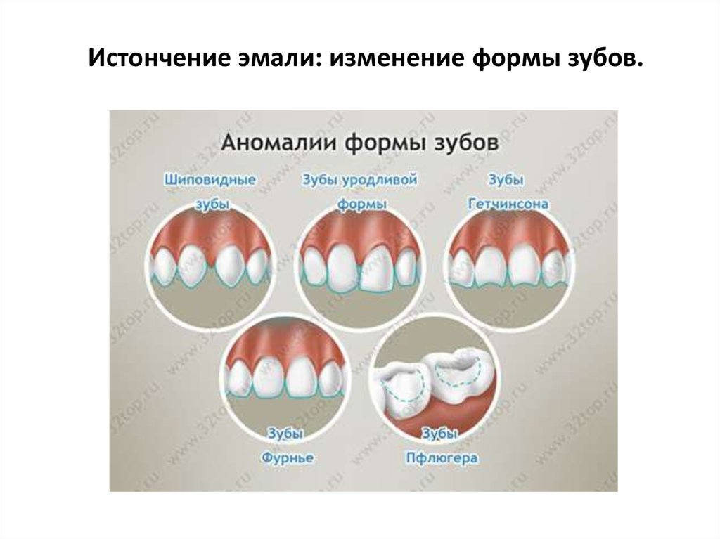 Презентация некариозные поражения твердых тканей зубов