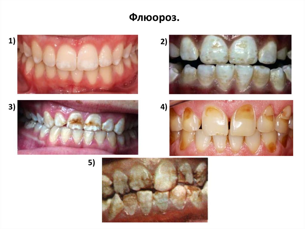 Презентация некариозные поражения твердых тканей зубов