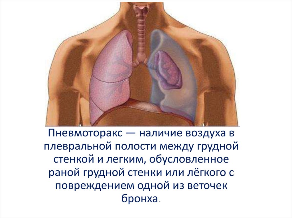 Презентация пневмоторакс и гемоторакс