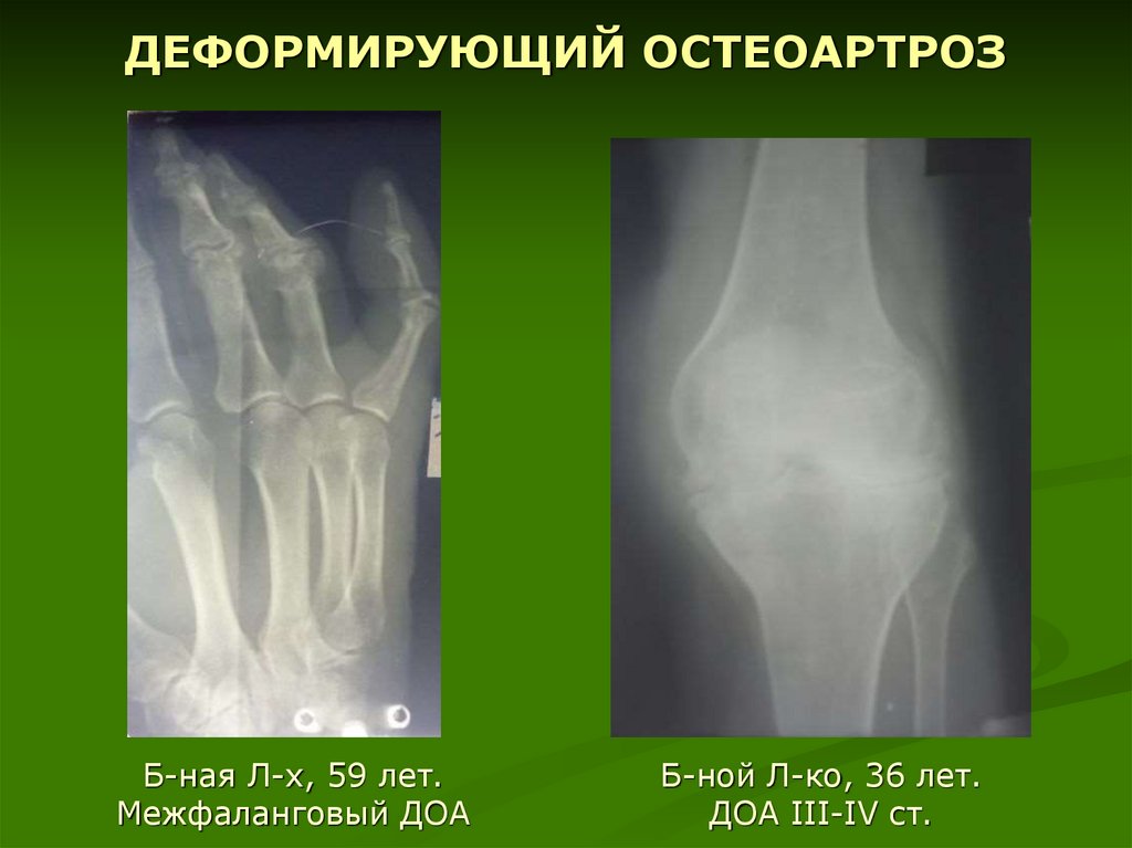 Остеоартроз это. Доа коленных суставов 3 ст рентген. .Деформирующий остеоартрит остеоартроз. Деформирующий остеоартроз рентген степени.
