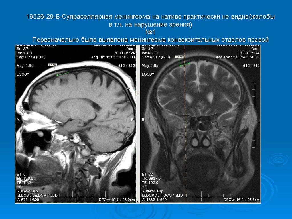 Супраселлярная цистерна пролабирует в полость