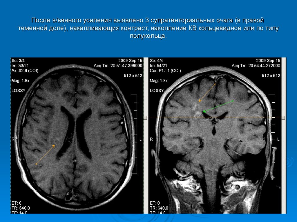 Мр картина множественных супратенториальных очагов глиоза что это