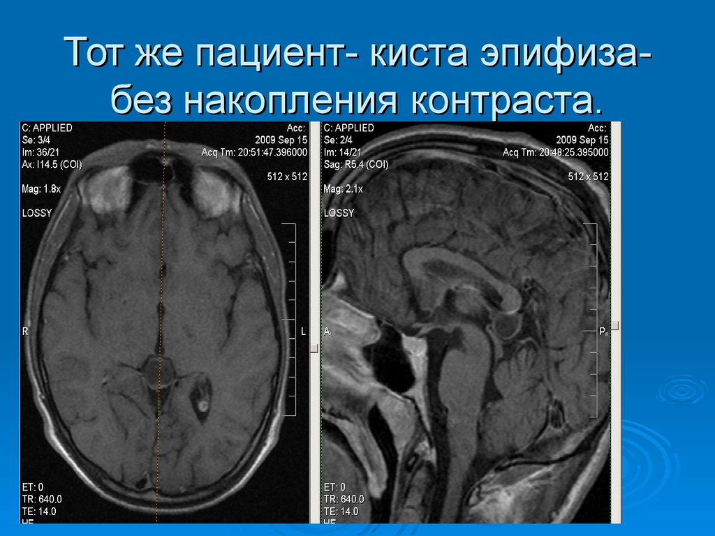 Трансформация шишковидной железы. Киста эпифиза в головном мозге на мрт. Арахноидальная киста эпифиза.