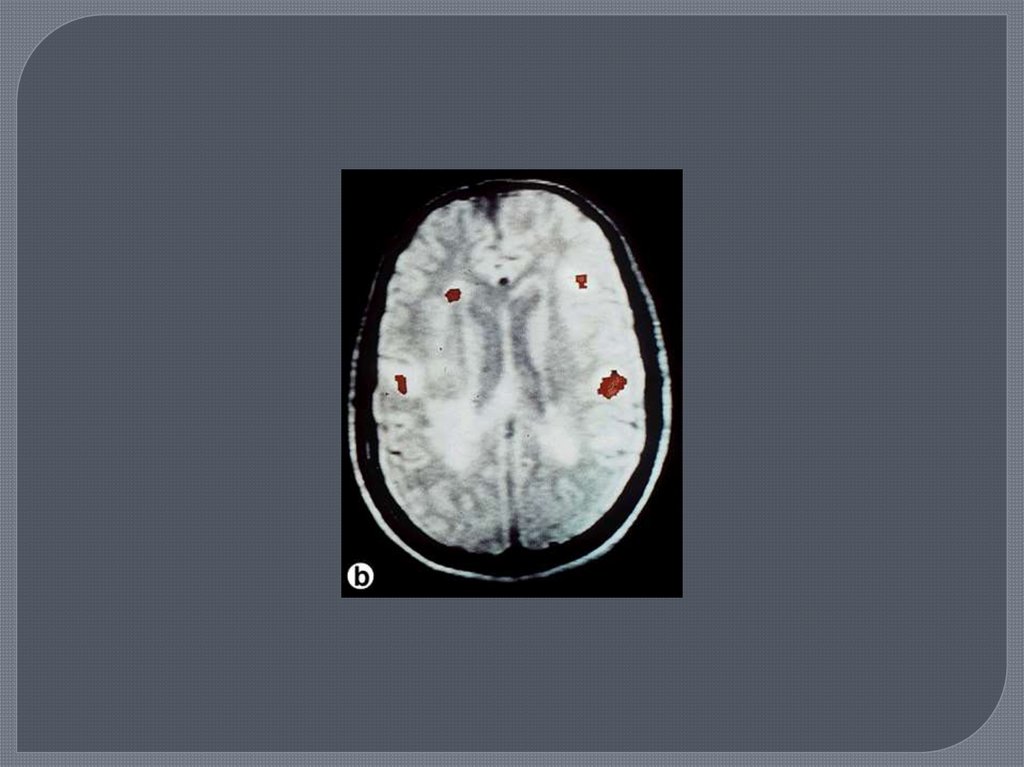 Демиелинизация головного. G35 демиелинизирующее заболевание. Демиелинизирующее заболевание ЦНС. Демиелинизирующее заболевание головного мозга классификация. G37.9 демиелинизирующая болезнь центральной нервной.