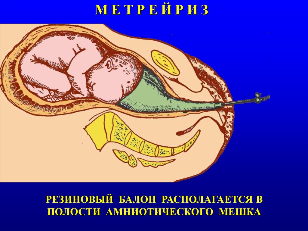 Поперечный разрез кесарево