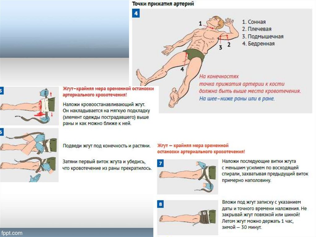 Наложение кровоостанавливающего жгута на бедро. Наложение жгута на бедренную артерию. Жгут в летнее время накладывают. На какое время накладывается кровоостанавливающий жгут летом и зимой. Сколько держать жгут летом и зимой.