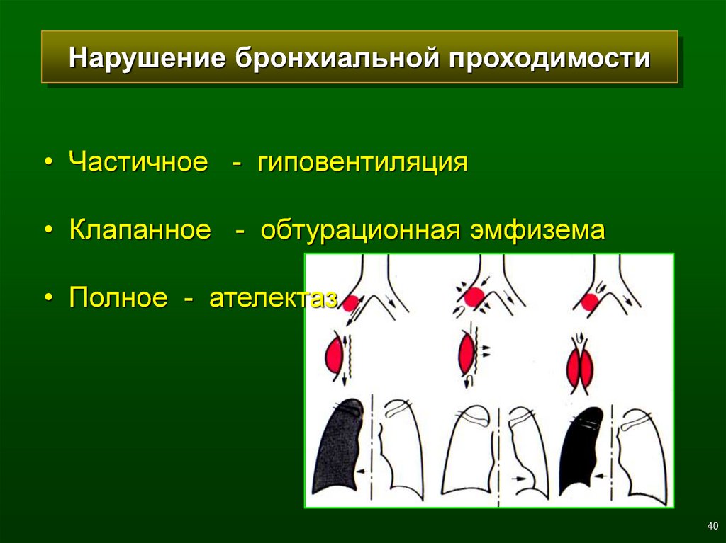 Нарушение проходимости. Стадии нарушения бронхиальной проходимости рентген. Синдром нарушения бронхиальной проходимости. Степени нарушения бронхиальной проходимости. Нарушение бронхиальной проходимости схема.