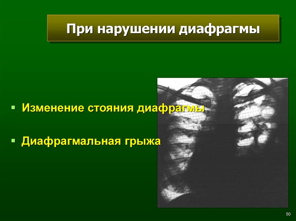 Лучевая диагностика заболеваний легких презентация