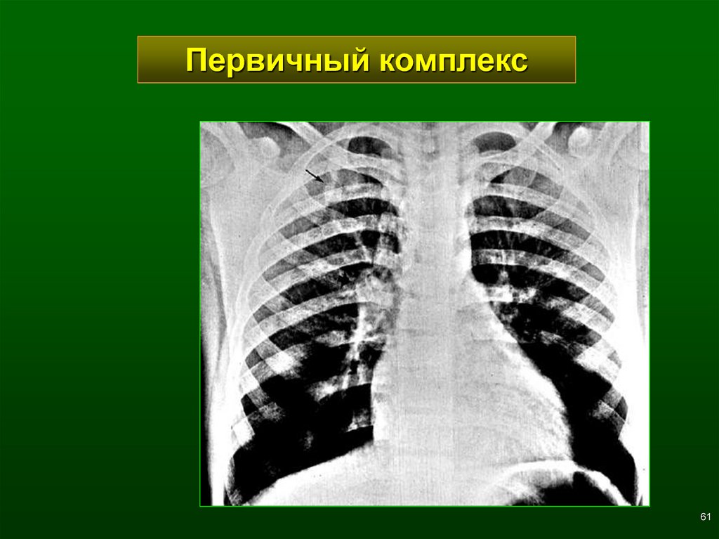 Лучевая диагностика заболеваний легких презентация