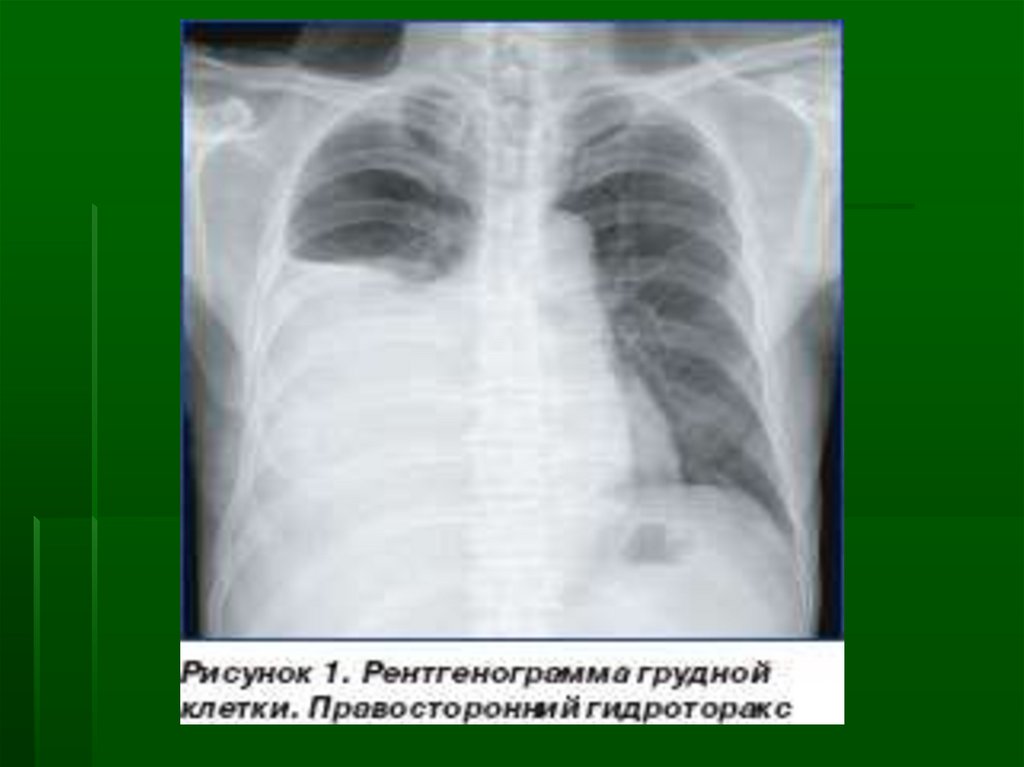 Признаки гидроторакса. Гидроторакс легкого рентген. Пиоторакс гидроторакс. Левосторонний гидроторакс рентген. Гемоторакс гидроторакс рентген.