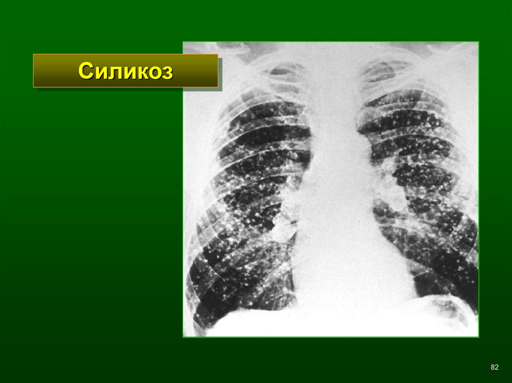 Силикоз. Силикоз легких рентген. Рентген легких силикатоз. Силикоз на рентгенограмме. Силикоз рентген.