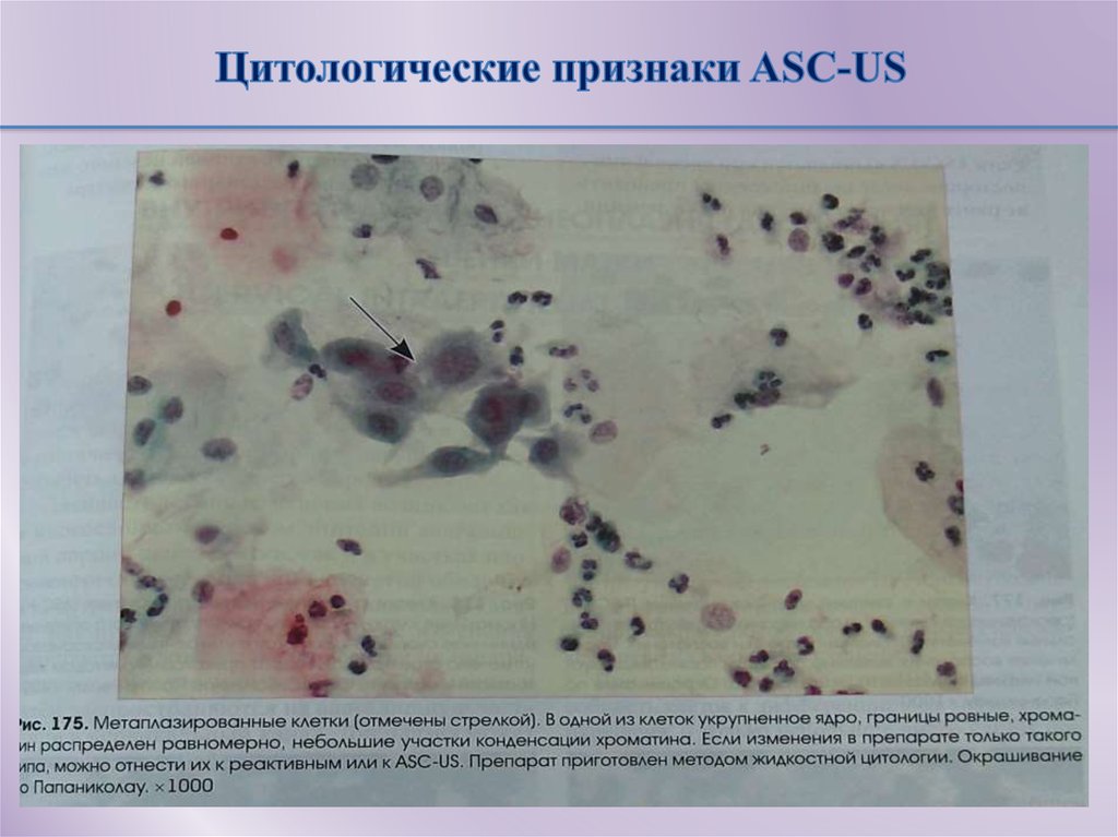 Клетки с признаками реактивных изменений. Атипия клеток плоского эпителия ASC-H. Цитологические изменения это. Цитологические снимки.