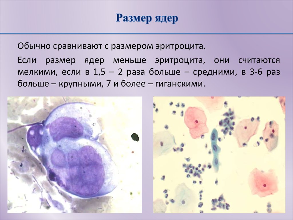 Единичные увеличенные ядра плоского. Дискореоз клеток плотного эпителия. Дискариоз клеток плоского эпителия шейки. Слабый дискариоз клеток плоского эпителия что это. Интраэпителиальные изменения.