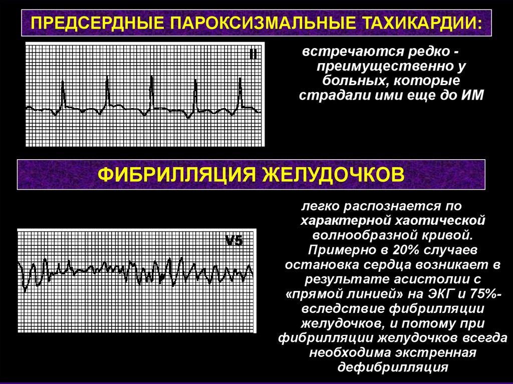 Пароксизмальная желудочковая тахикардия карта вызова смп