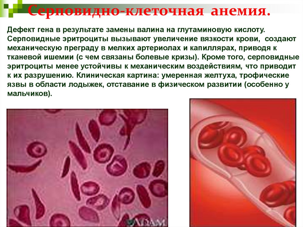 Анемия и эритроциты в крови. Серповидная анемия эритроциты. Эритроциты при серповидноклеточной анемии. Серповидная клеточная анемия генная мутация. Серповидноклеточная анемия Валин.