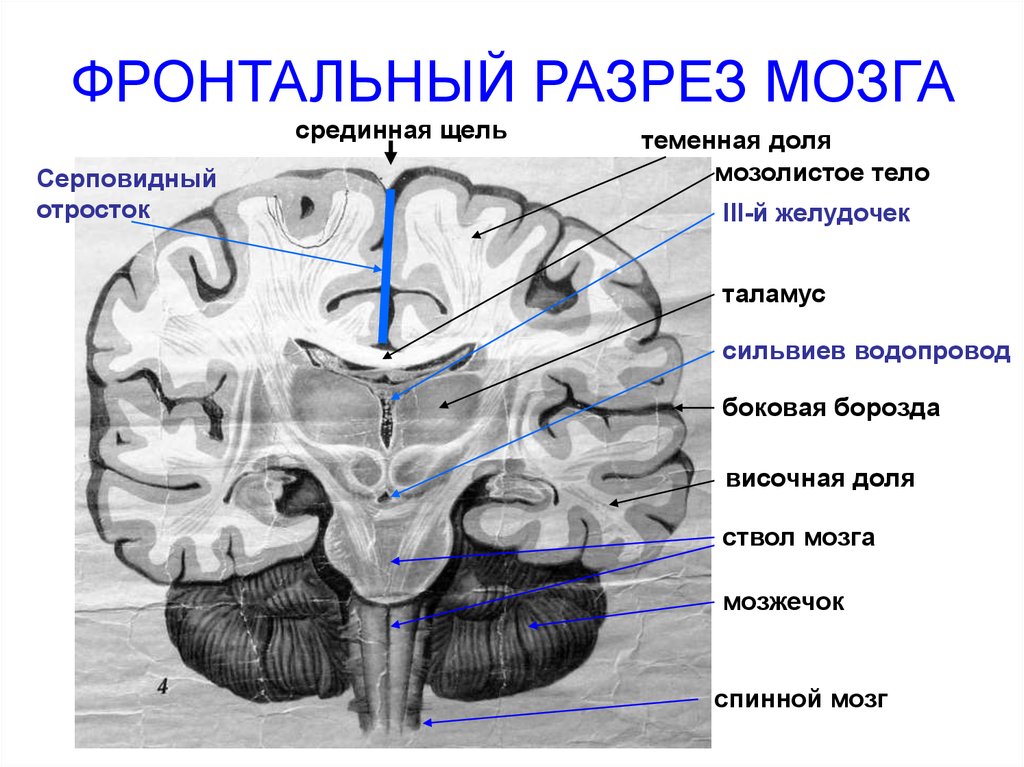 Длинные отростки головного мозга. Строение головного мозга фронтальный срез. Фронтальный разрез мозга анатомия. Поперечный срез головного мозга мозга. Третий желудочек головного мозга анатомия.
