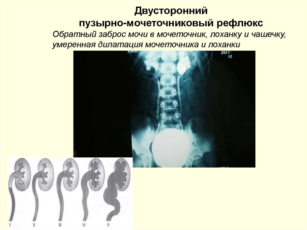 Пузырно мочеточниковый рефлюкс презентация