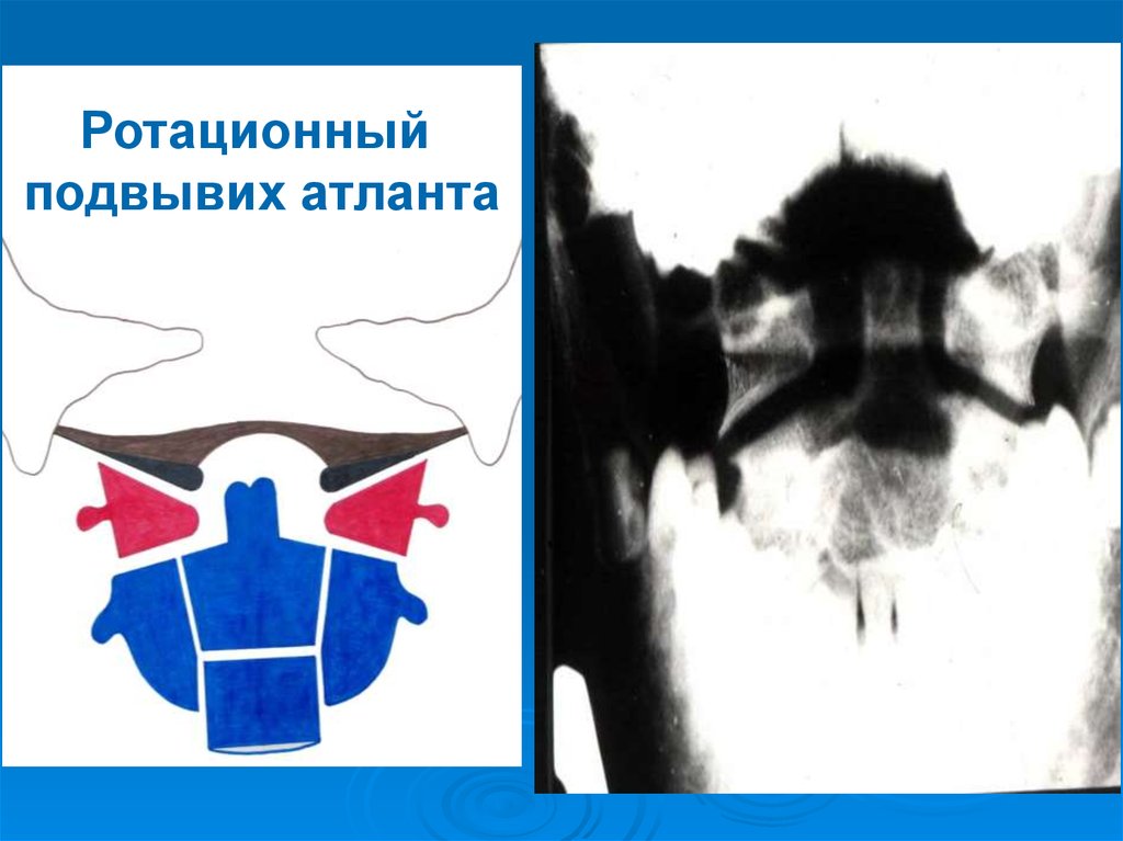 Ротационный подвывих. Ротационный подвывих Атланта с1. Ротационный подвывих Атланта у детей. Атлант подвывих. Правосторонний подвывих Атланта.