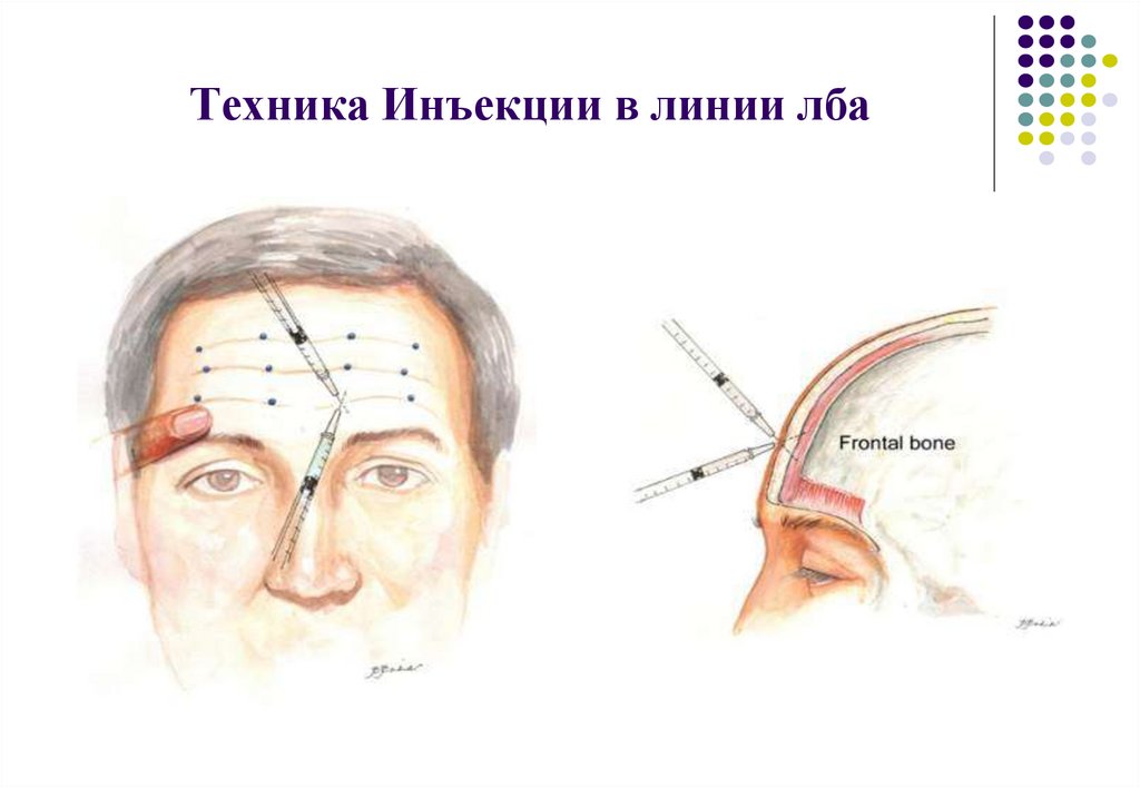 Схема мезотерапии лица