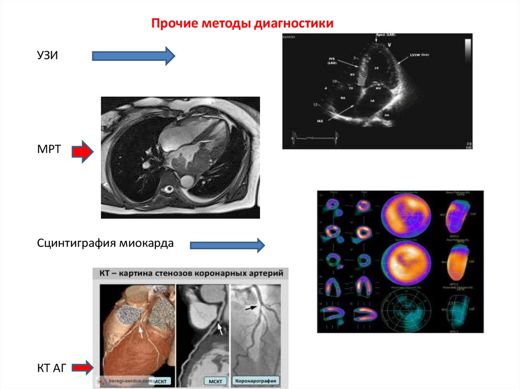 Кт скрининг коронарного кальция