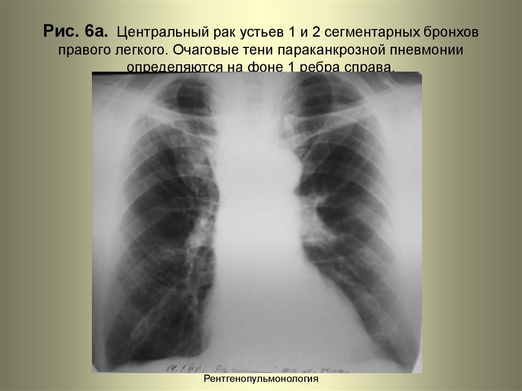 Центральный рак правого. Параканкрозная пневмония рентген. Очаговые тени пневмонии. Периканкренозная пневмония. Центральные опухоли легких.