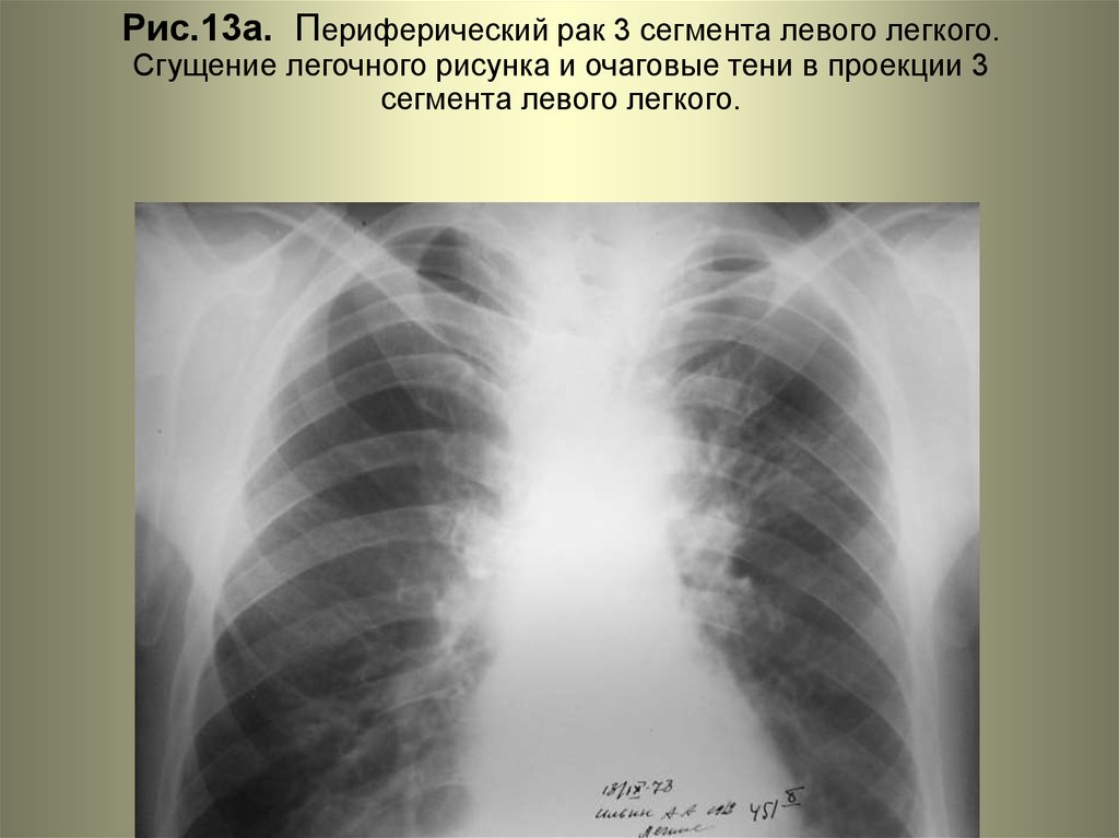 Усиление легочного рисунка флюорография