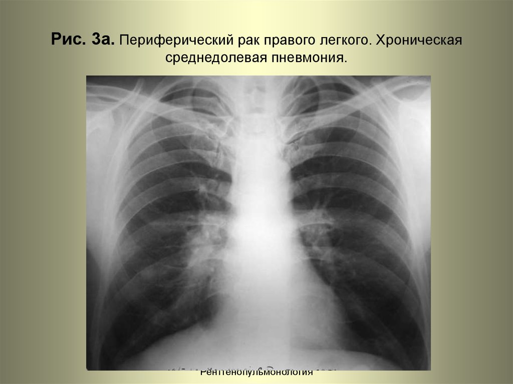 Рак нижней доли. Среднедолевая пневмония правого легкого рентген. Периферический са правого легкого. Среднедолевая пневмония рентген. Очаговая пневмония среднедолевая.