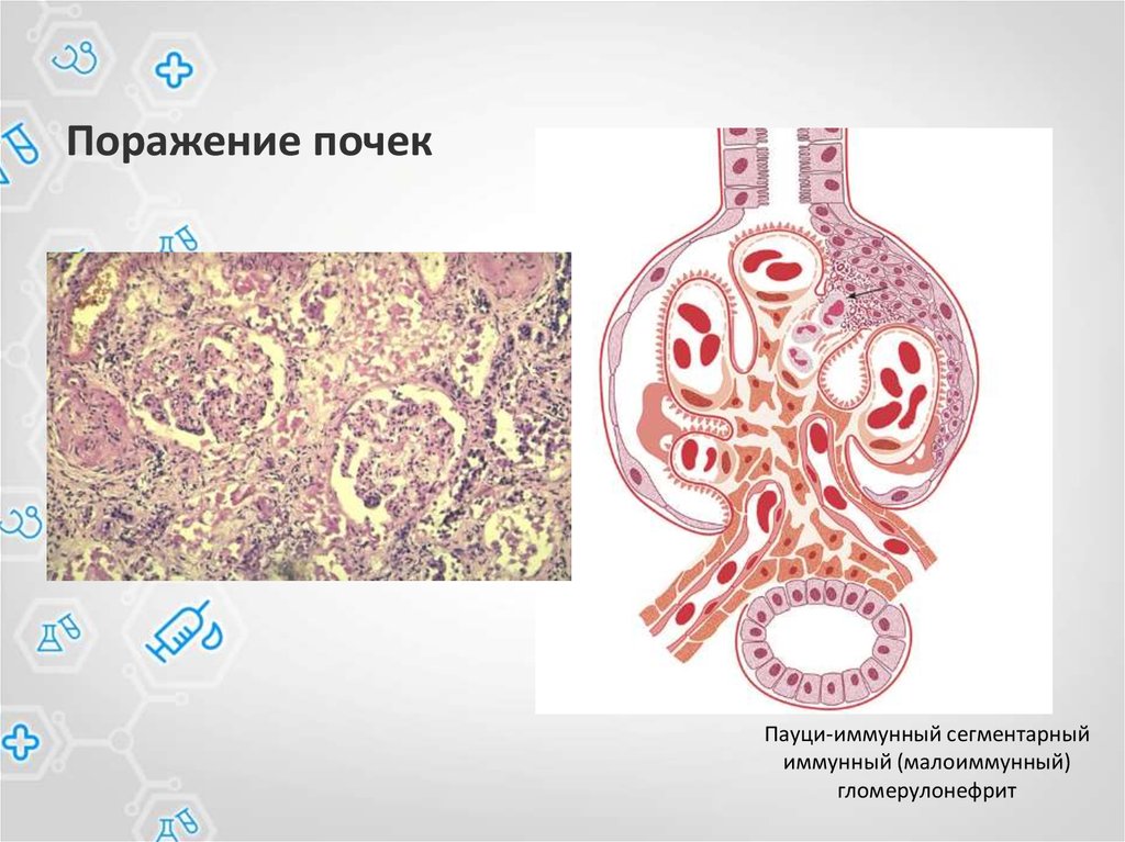 Гломерулонефрит картинки для презентации