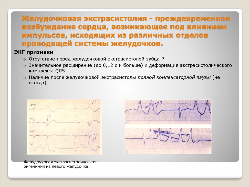 Желудочные экстрасистолы