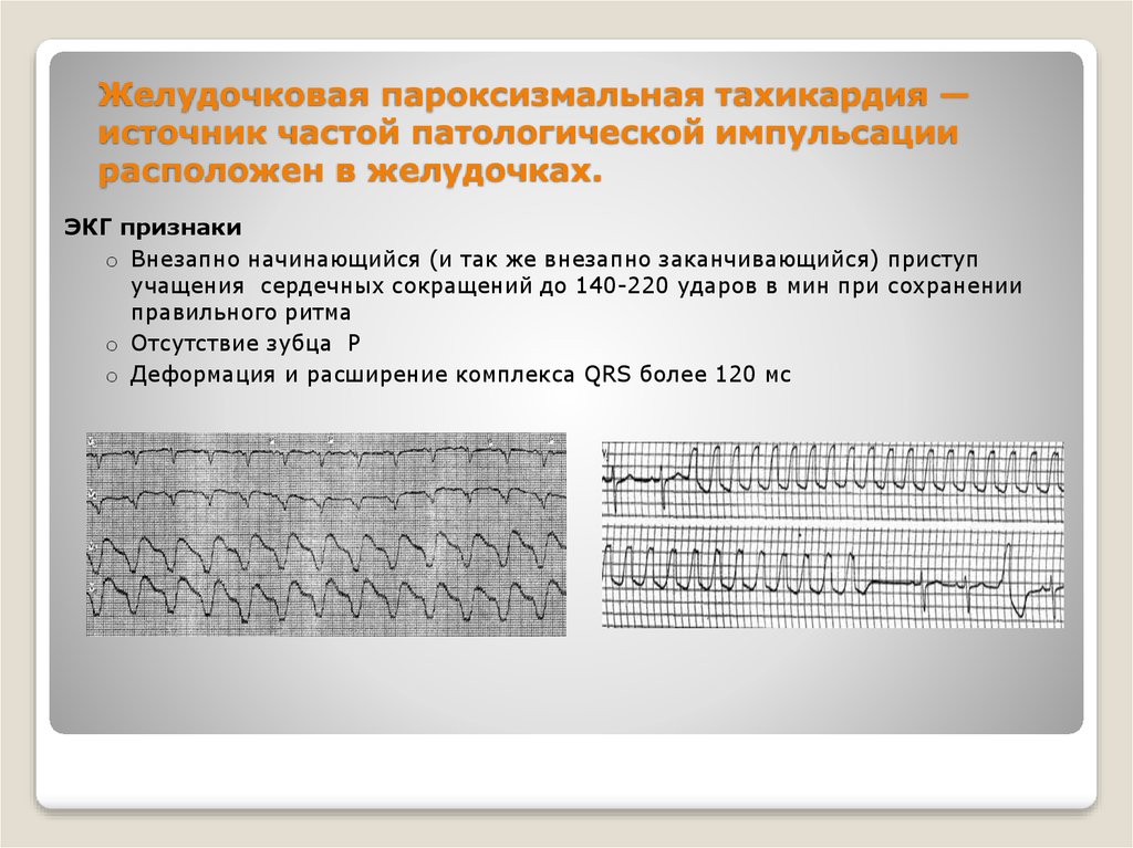 Пароксизмальная желудочковая тахикардия карта вызова смп