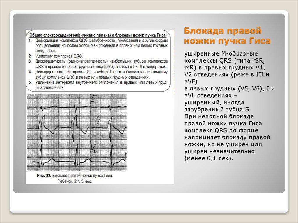 Блокада ножек пучка гиса. Признаки неполной блокады правой ножки пучка Гиса. Неполная блокада ножки Гиса у ребенка. Блокада ножек пучка Гиса презентация. Замедление проведения по правой ножке пучка Гиса.