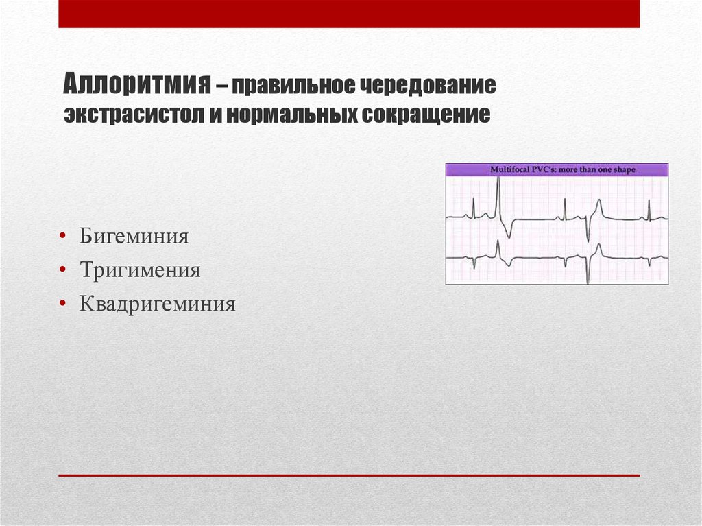 Экстрасистолия лечение. Экстрасистолия бигеминия тригеминия квадригеминия. Квадригеминия ЭКГ. Желудочковая экстрасистолия квадригеминия. Аллоритмия на ЭКГ.