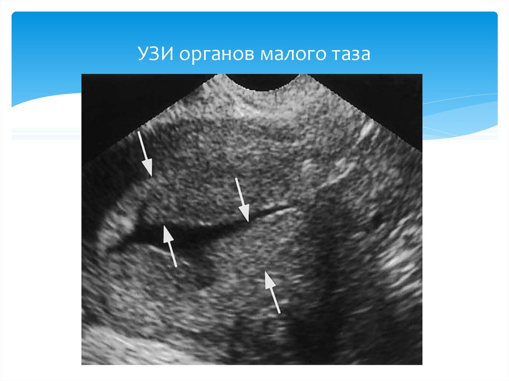 Узи мал. Ультразвуковое исследование органов малого таза трансректальное. УЗИ малого таза ОМТ что это. УЗД органов малого таза. Эхография органов малого таза.